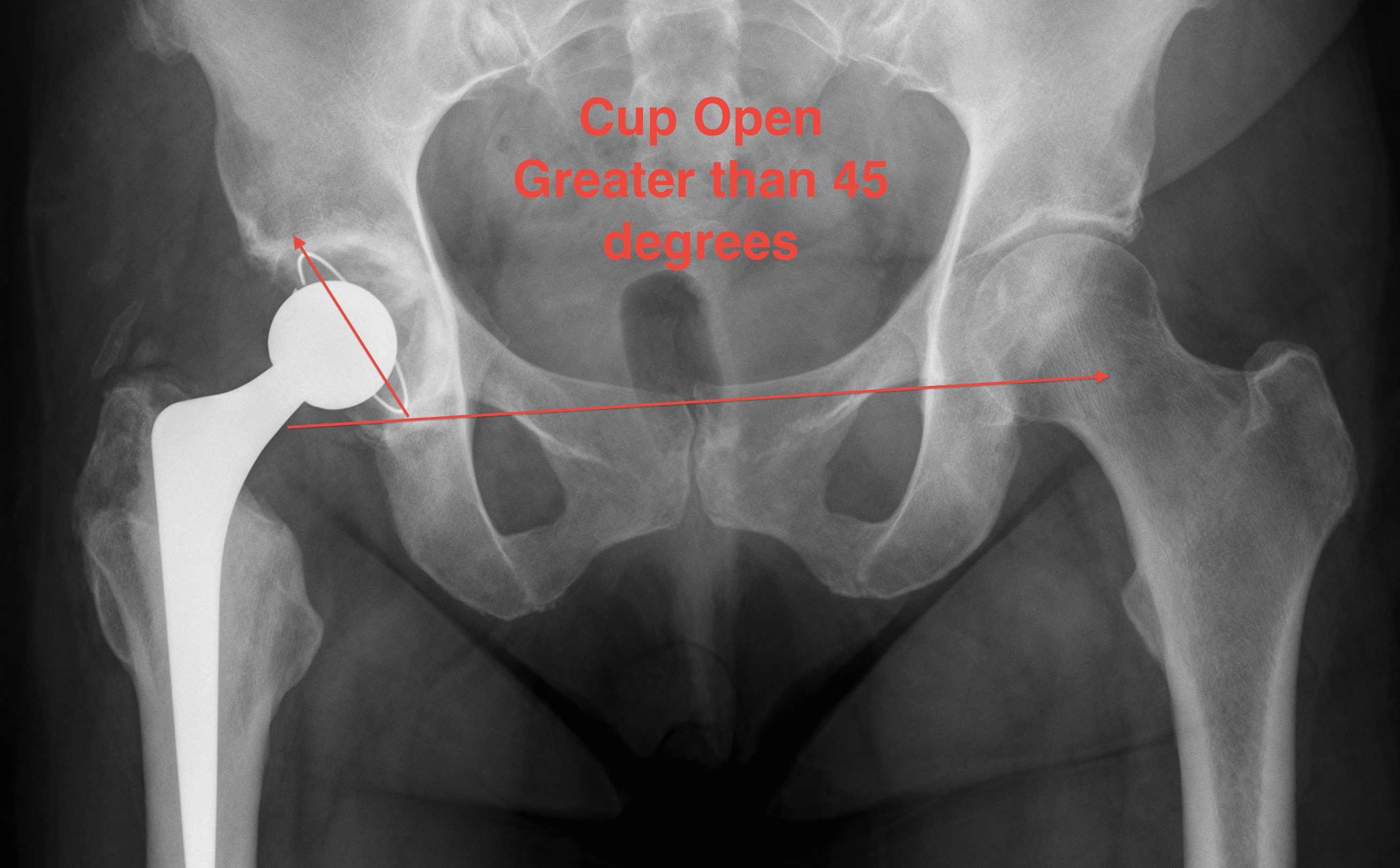 THR Acetabulum open > 45 degrees